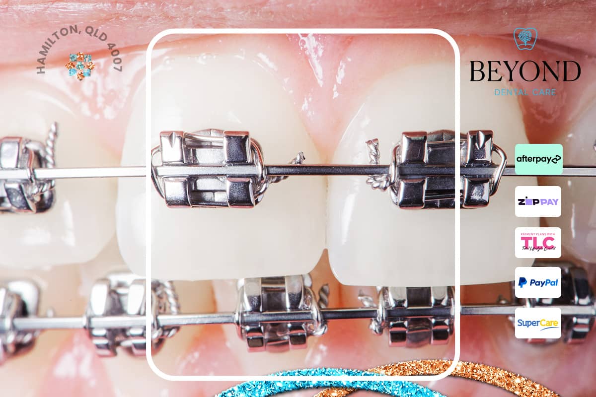 Emergency orthodontic correction of a misaligned or detached braces bracket