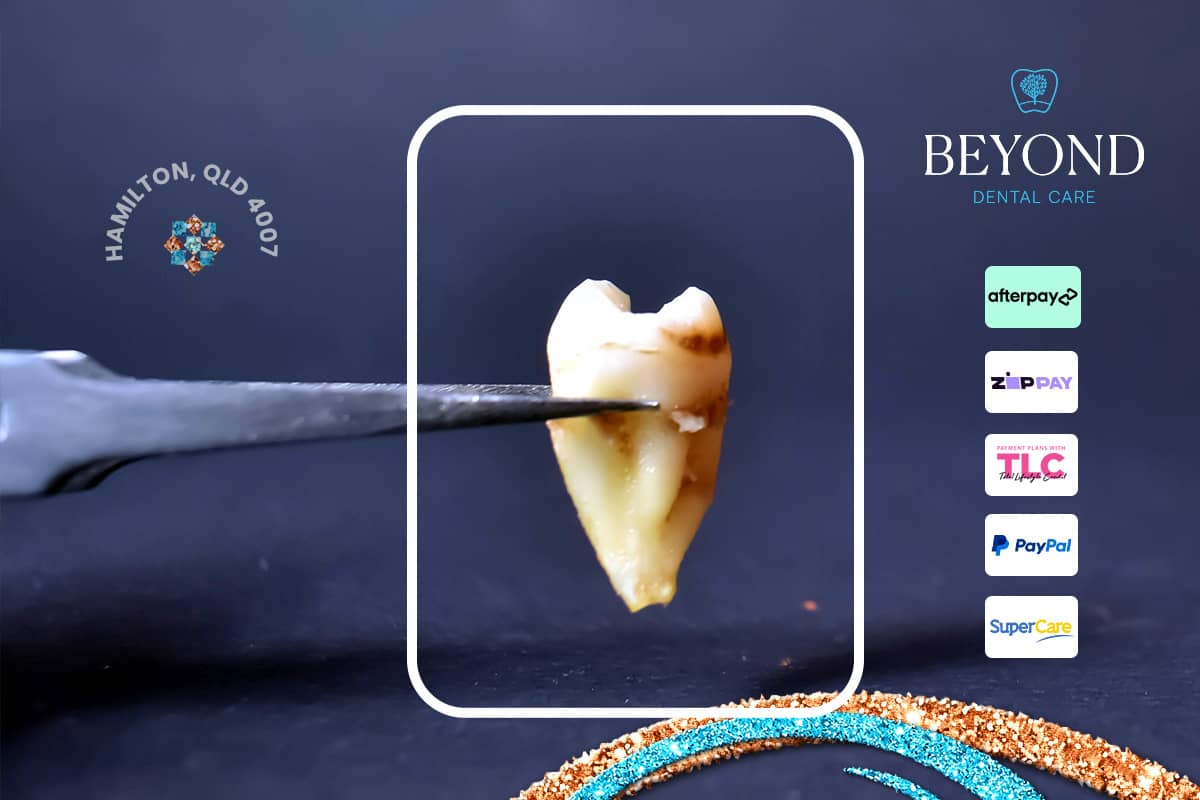 Emergency treatment for pain caused by a cracked molar