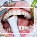 Emergency treatment for severe pain following a dental filling