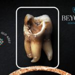 Emergency dental procedure for severe tooth decay affecting the nerve