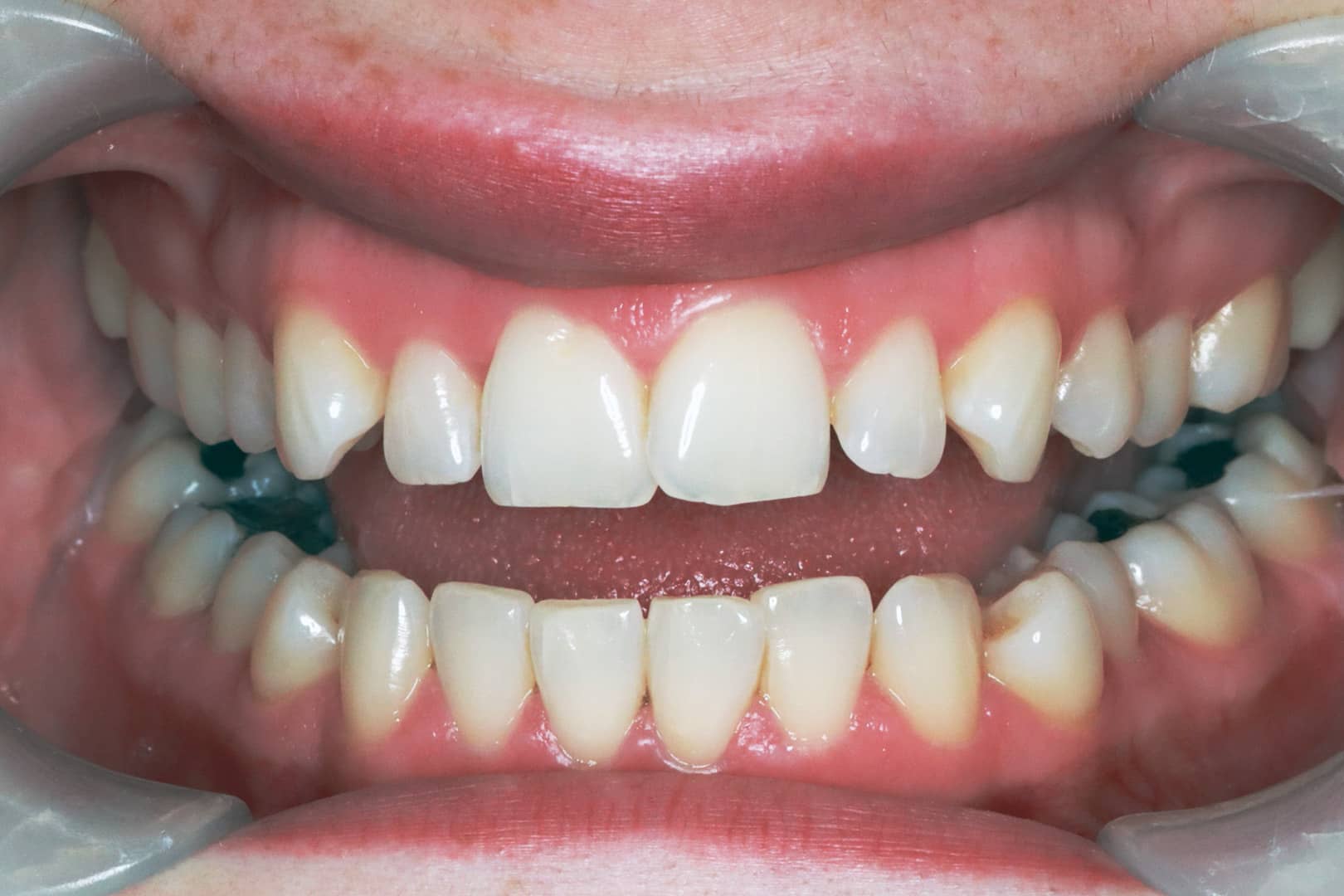 Upper front teeth with visible spacing and mild crowding before braces