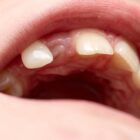preview Dry Socket After Tooth Extraction Emergency Treatment Card