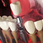 tooth implant in articifical jaw