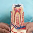 tooth incision with caries
